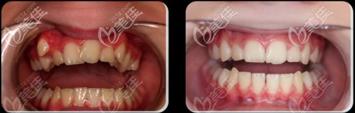 貴陽美萊口腔陳燕醫(yī)生金屬托槽矯正案例