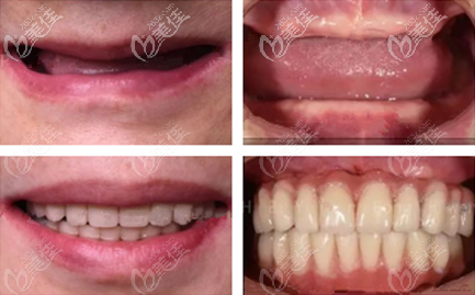 貴陽美萊口腔張俊醫(yī)生種植牙案例