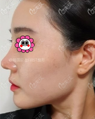 在韓國(guó)做耳軟骨鼻綜合沒(méi)我想的那么疼,恢復(fù)有一個(gè)多月就比較自然了