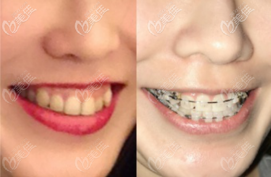 露齦笑做正畸的術(shù)前術(shù)后對比圖 露齦笑做正畸的術(shù)前術(shù)后對比圖