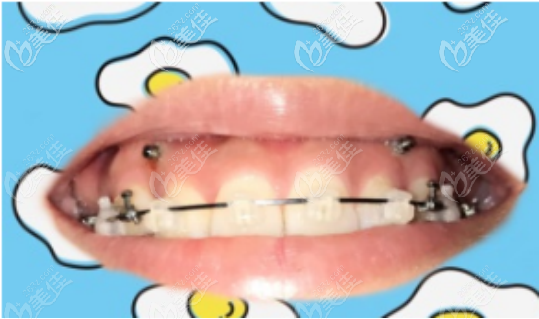 談?wù)勎衣洱l笑做正畸的費(fèi)用和效果（沒(méi)反彈而且改善程度挺明顯的）