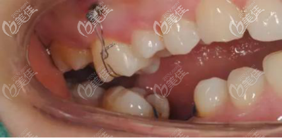 支抗釘?shù)奈恢? alt=