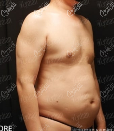 術(shù)前的大肚腩 術(shù)前的大肚腩