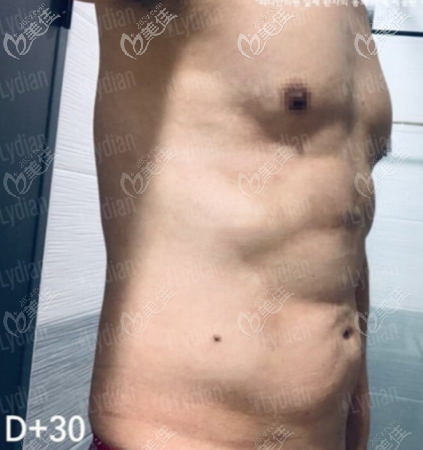 30天效果圖 30天效果圖