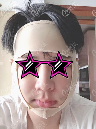 下頜角手術(shù)后戴頭套照片