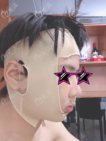 削骨手術(shù)后包扎樣子