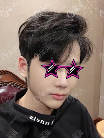 下頜角手術(shù)恢復(fù)過(guò)程圖