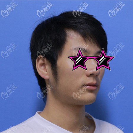 側(cè)面下頜骨肥大很難看