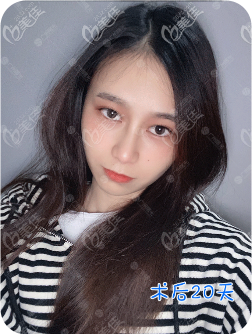 雙側(cè)耳軟骨鼻綜合隆鼻20天恢復(fù)期效果圖 雙側(cè)耳軟骨鼻綜合隆鼻20天恢復(fù)期效果圖