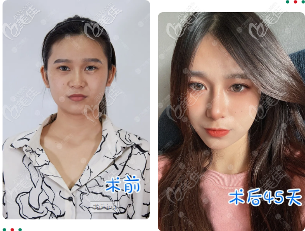 雙側(cè)耳軟骨隆鼻已經(jīng)45天前后對(duì)比圖片 雙側(cè)耳軟骨隆鼻已經(jīng)45天前后對(duì)比圖片
