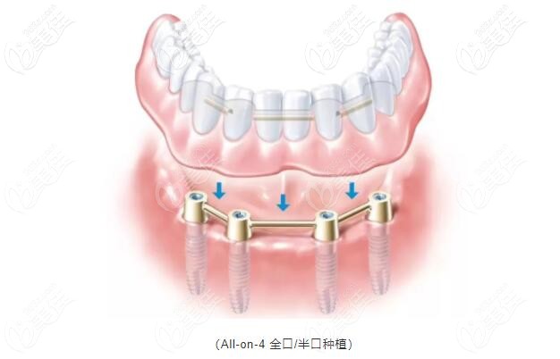 all-on-4種植牙 all-on-4種植牙