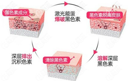 超皮秒去黑眼圈過程示意圖