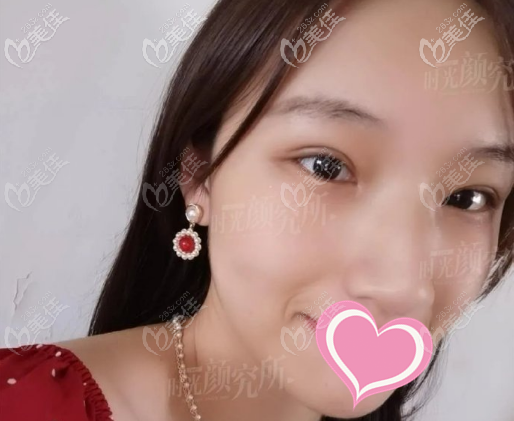 <!--<i data=20240703-sp></i>-->時(shí)光許黎平全切雙眼皮案例術(shù)后兩個(gè)月 <!--<i data=20240703-sp></i>-->時(shí)光許黎平全切雙眼皮案例術(shù)后兩個(gè)月