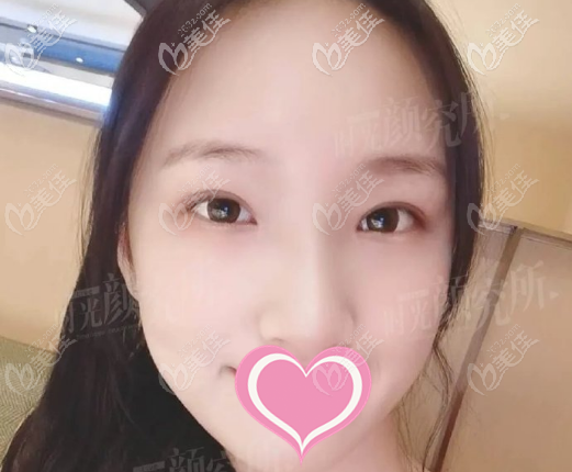 <!--<i data=20240703-sp></i>-->時(shí)光許黎平全切雙眼皮案例術(shù)后四個(gè)月 <!--<i data=20240703-sp></i>-->時(shí)光許黎平全切雙眼皮案例術(shù)后四個(gè)月