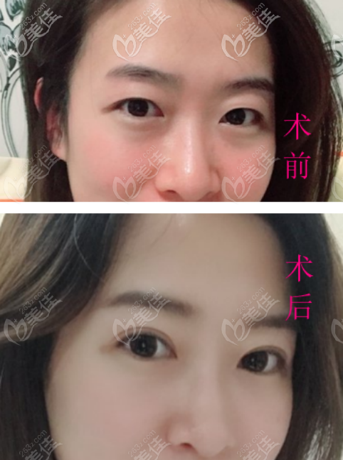 <!--<i data=20240703-sp></i>-->張筠莉醫(yī)生雙眼皮案例一 <!--<i data=20240703-sp></i>-->張筠莉醫(yī)生雙眼皮案例一