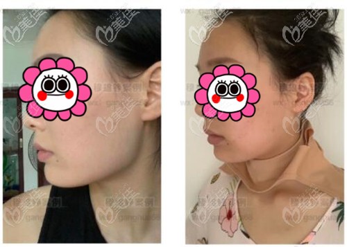 穆雄錚下頜角手術(shù)案例 穆雄錚下頜角手術(shù)案例