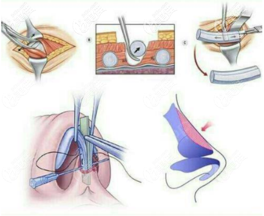 李攀醫(yī)生肋軟骨隆鼻 李攀醫(yī)生肋軟骨隆鼻