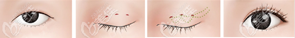埋線雙眼皮手術(shù)原理示意圖