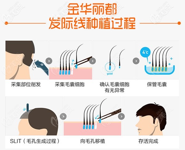 金華麗都植發(fā)優(yōu)勢