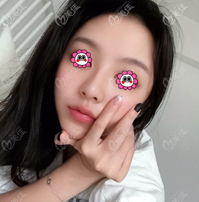 做埋線提升有一個多月了