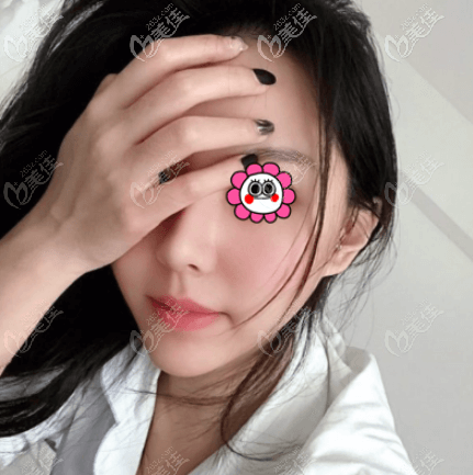 杜寧面部埋線提升案例效果