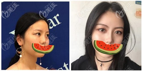 譚立文隆鼻手術案例