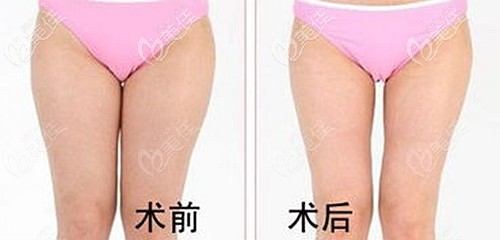 成都毛健清吸脂怎么樣