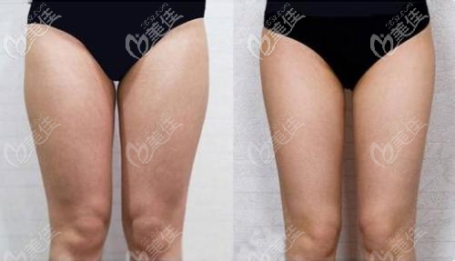 李烈大腿吸脂案例