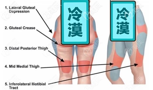 大腿環(huán)吸抽脂部位分布圖 大腿環(huán)吸抽脂部位分布圖