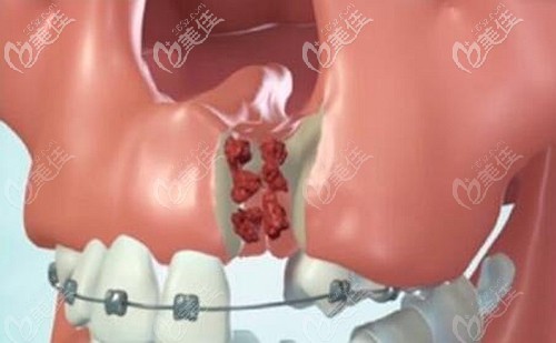 牙槽骨突裂植骨手術(shù)的原理 牙槽骨突裂植骨手術(shù)的原理