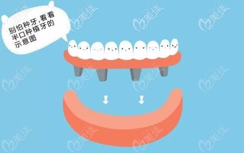 半口種植牙的示意圖 半口種植牙的示意圖