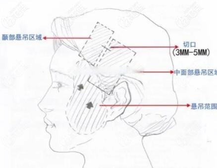 小拉皮切口部位示意圖