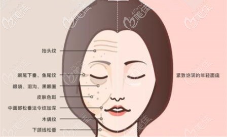 抗衰除皺做拉皮手術(shù)多久能恢復(fù)好