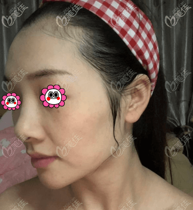 超皮秒去黃褐斑有一個月了