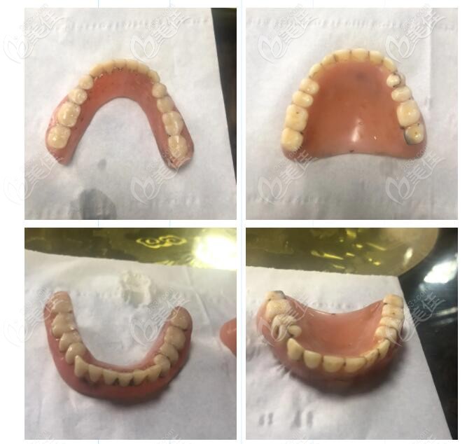 這是婆婆帶了20年的活動(dòng)假牙