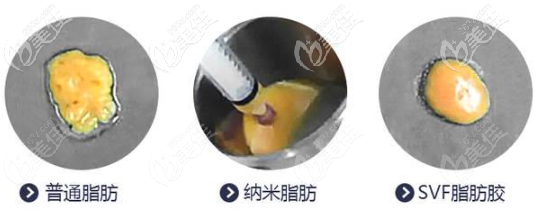SVF脂肪膠，納米脂肪和普通自體脂肪哪個豐胸好