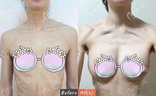 普通自體脂肪300毫升豐胸增大2個罩杯效果圖