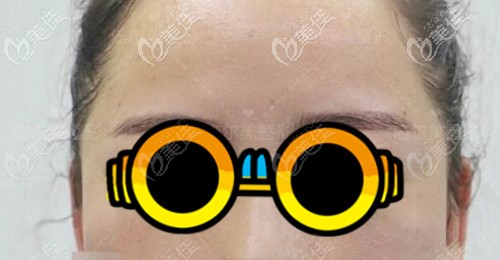 脂肪填充太陽(yáng)穴術(shù)后6個(gè)月效果