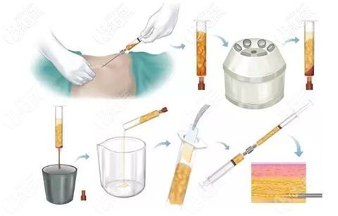 脂肪填充過(guò)程