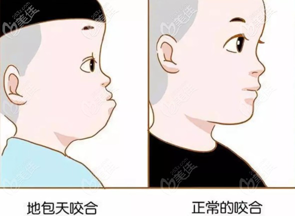 “地包天”面型和正常面型的區(qū)別圖 “地包天”面型和正常面型的區(qū)別圖