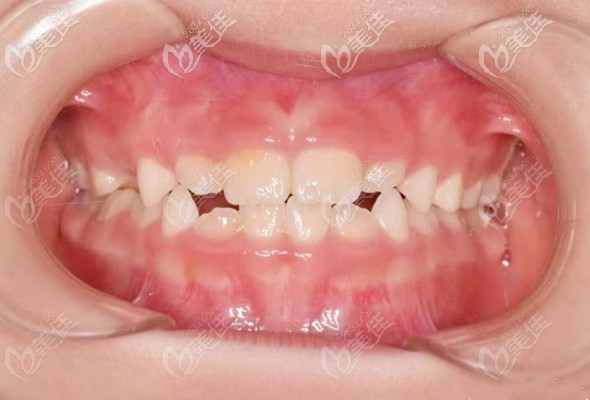 帶孩子在北京朝陽區(qū)瑞泰口腔醫(yī)院做的羅慕兒童牙齒矯正,效果比預(yù)期的要好