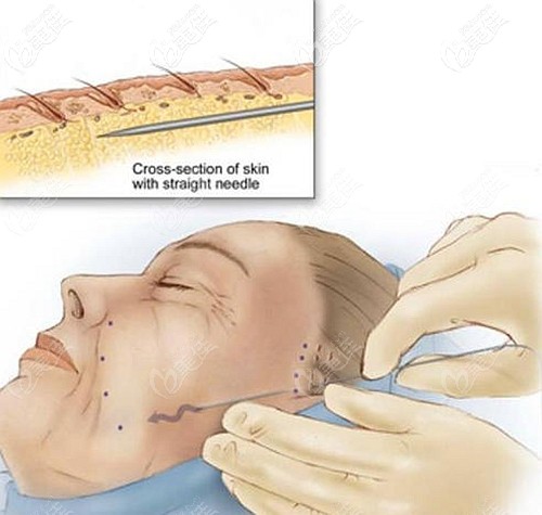 張年翁醫(yī)生做全臉埋線提升的優(yōu)勢