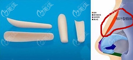 柳葉型假體隆鼻的利弊