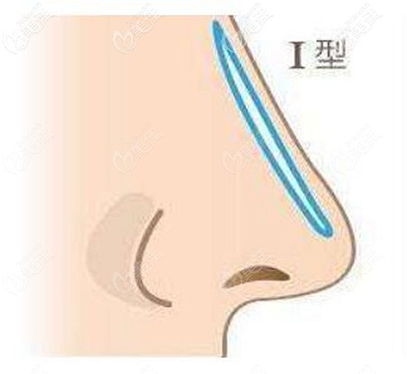 I型假體隆鼻的優(yōu)缺點