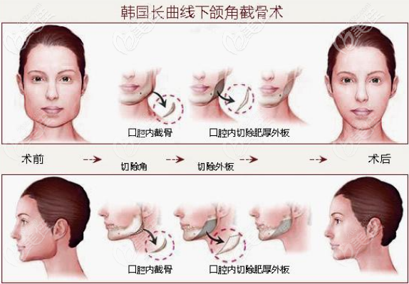 朱權醫(yī)生長曲線下頜角截骨術 朱權醫(yī)生長曲線下頜角截骨術