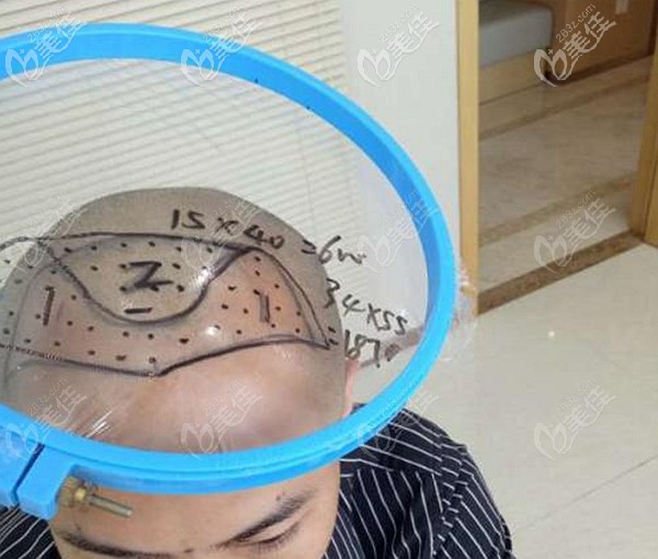 不同的植發(fā)密度價格不等