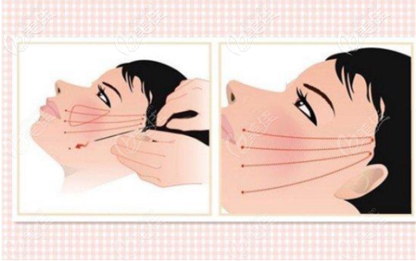 裴俊晟醫(yī)生做埋線提升手術(shù)的全過程 裴俊晟醫(yī)生做埋線提升手術(shù)的全過程