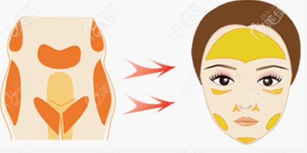 自體脂肪填充臉部后更松弛下垂了