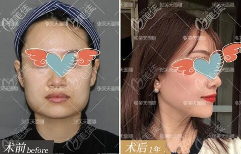 北京圣嘉新張笑天做的下頜角長曲線截骨實例前后對比圖