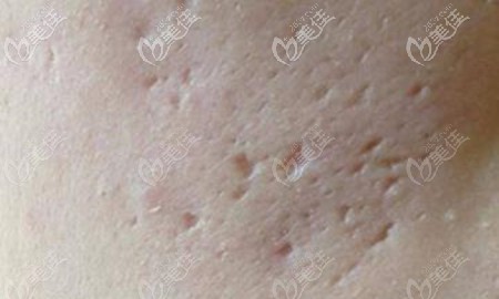 冰錐型痘坑圖片